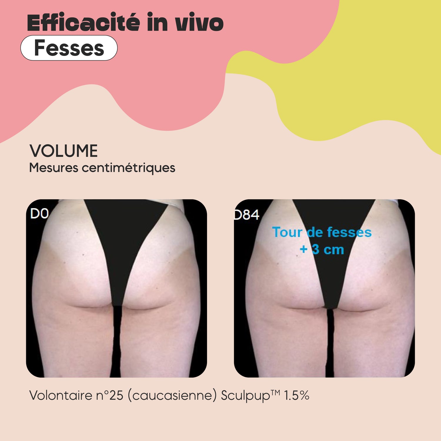 SHAPE AND CONTOUR TREATMENT FOR THE BUTTOCKS
